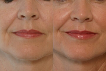 Fillers before and after photos in Houston, TX, Patient 28486