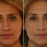 Fillers before and after photos in Houston, TX, Patient 28492