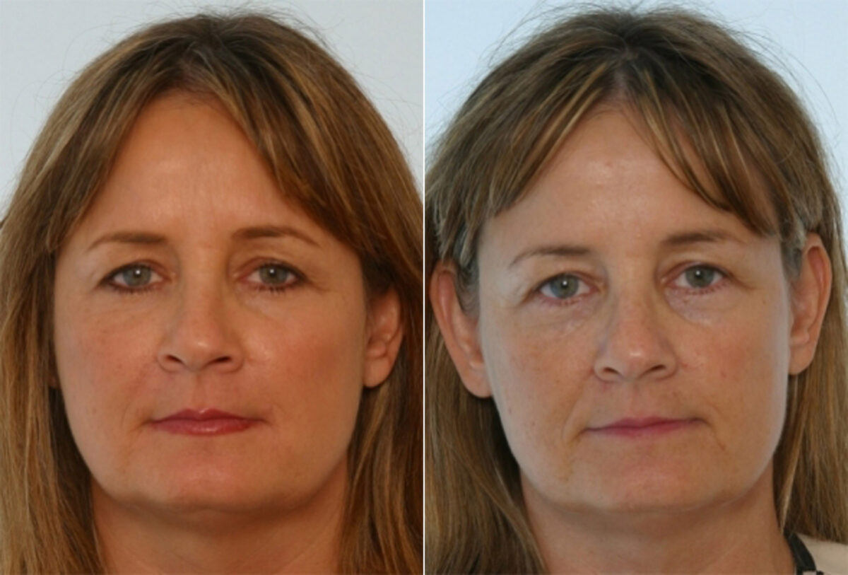 Fillers before and after photos in Houston, TX, Patient 28497