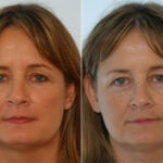 Fillers before and after photos in Houston, TX, Patient 28497