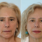 Fillers before and after photos in Houston, TX, Patient 28500