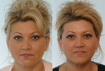 Fillers before and after photos in Houston, TX, Patient 28503