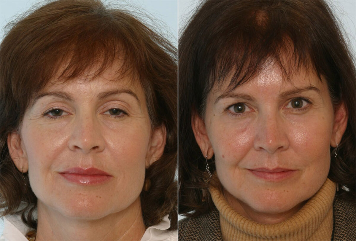 Fillers before and after photos in Houston, TX, Patient 28506