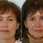 Fillers before and after photos in Houston, TX, Patient 28506