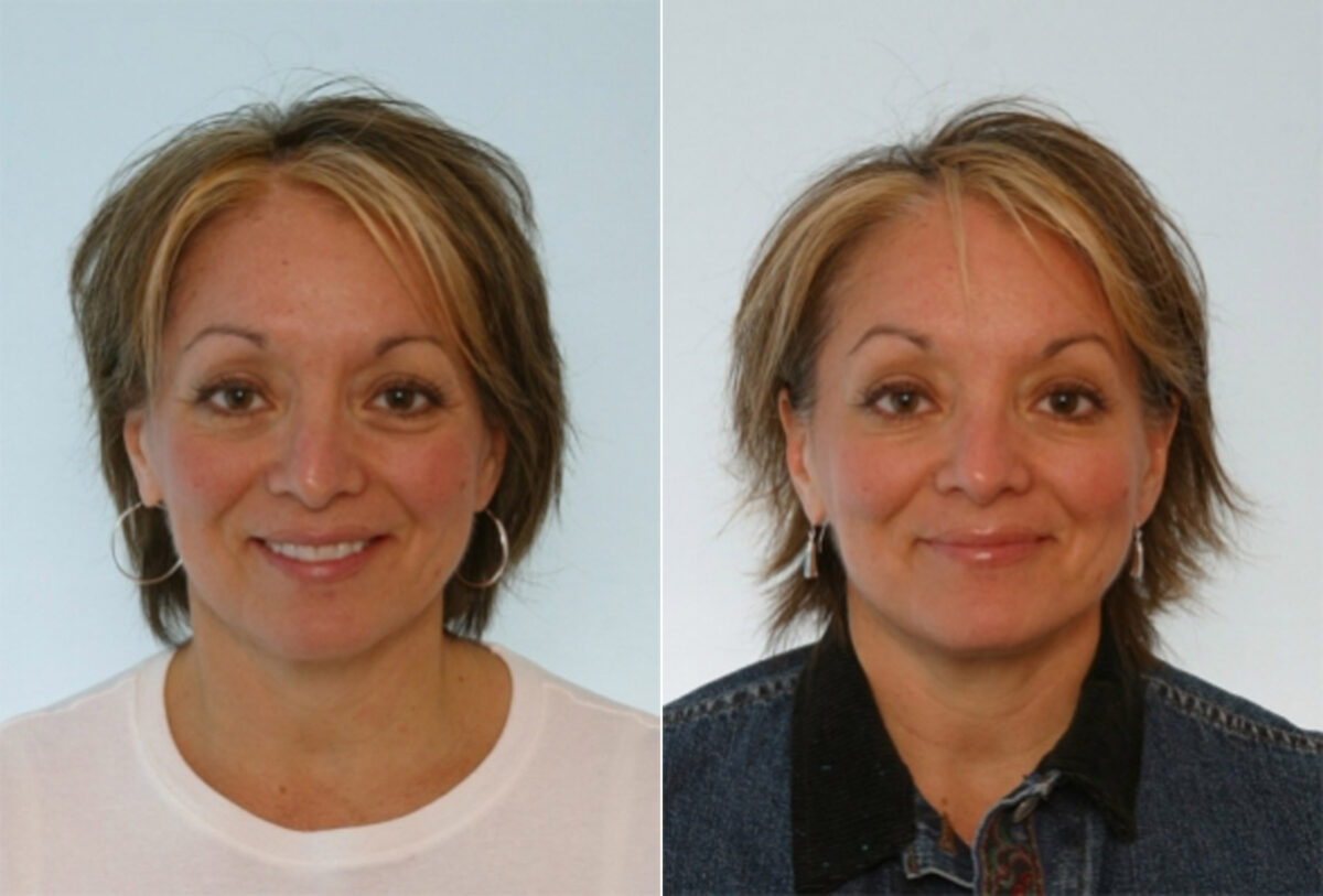 Fillers before and after photos in Houston, TX, Patient 28509