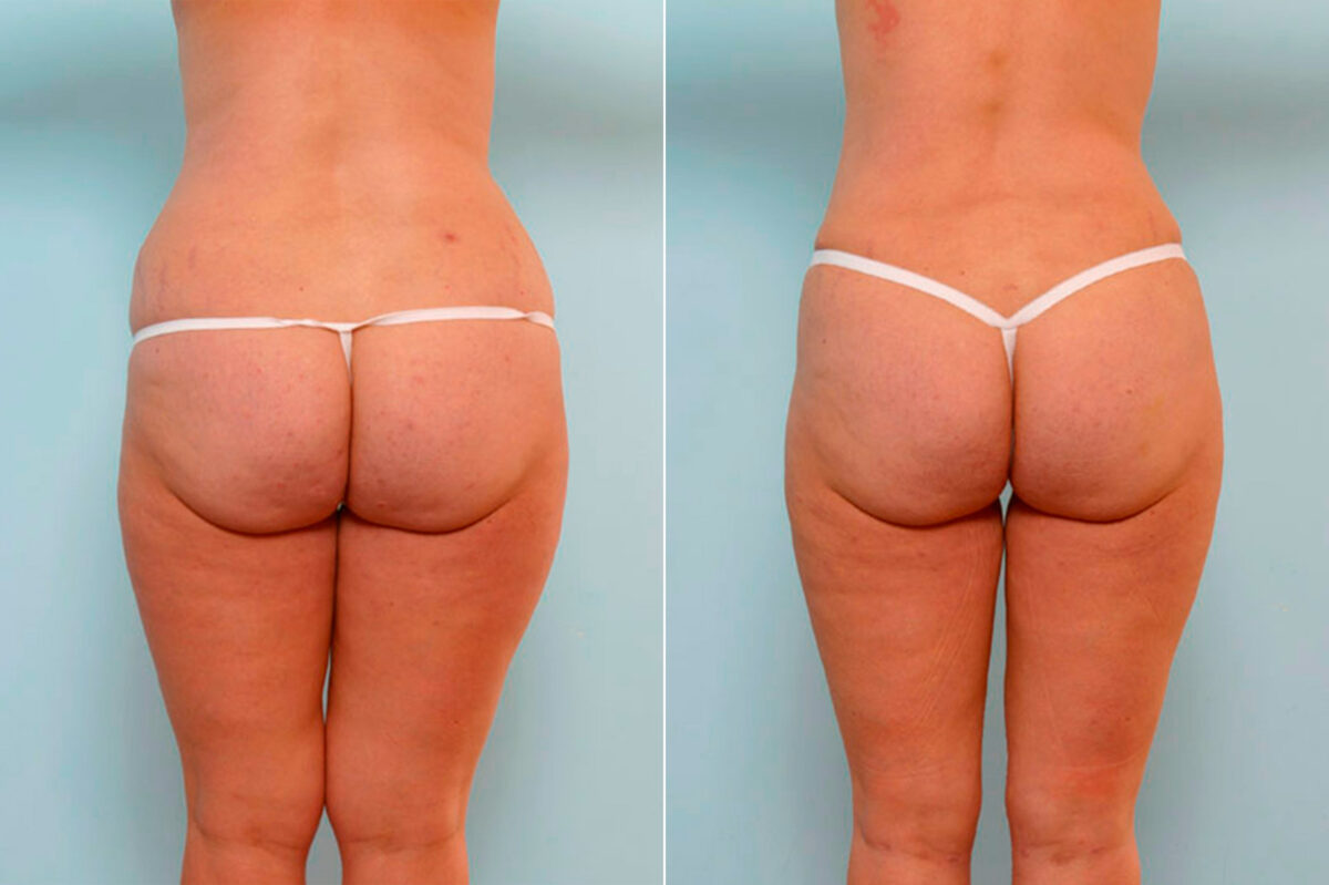 Abdominoplasty before and after photos in Houston, TX, Patient 24624