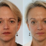 Fillers before and after photos in Houston, TX, Patient 28514