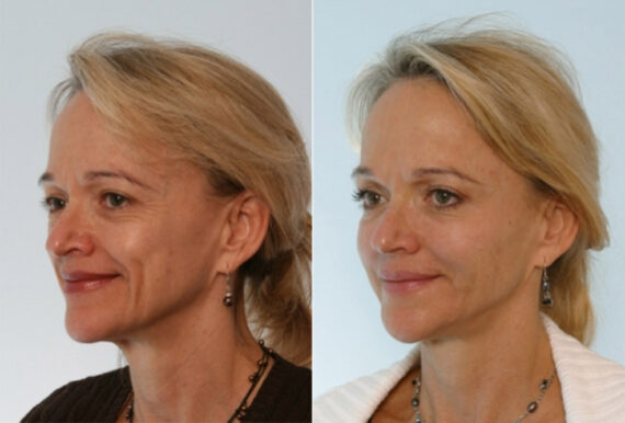 Fillers before and after photos in Houston, TX, Patient 28514