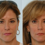 Fillers before and after photos in Houston, TX, Patient 28519