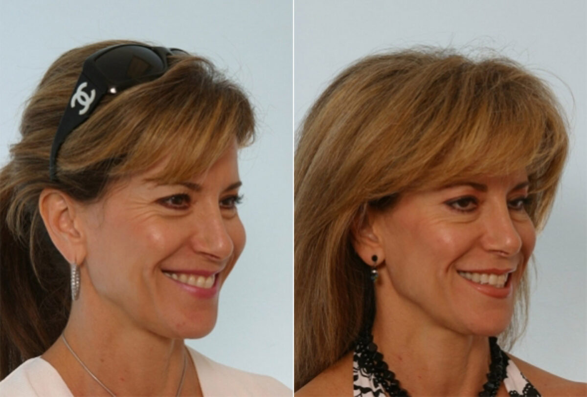 Fillers before and after photos in Houston, TX, Patient 28519