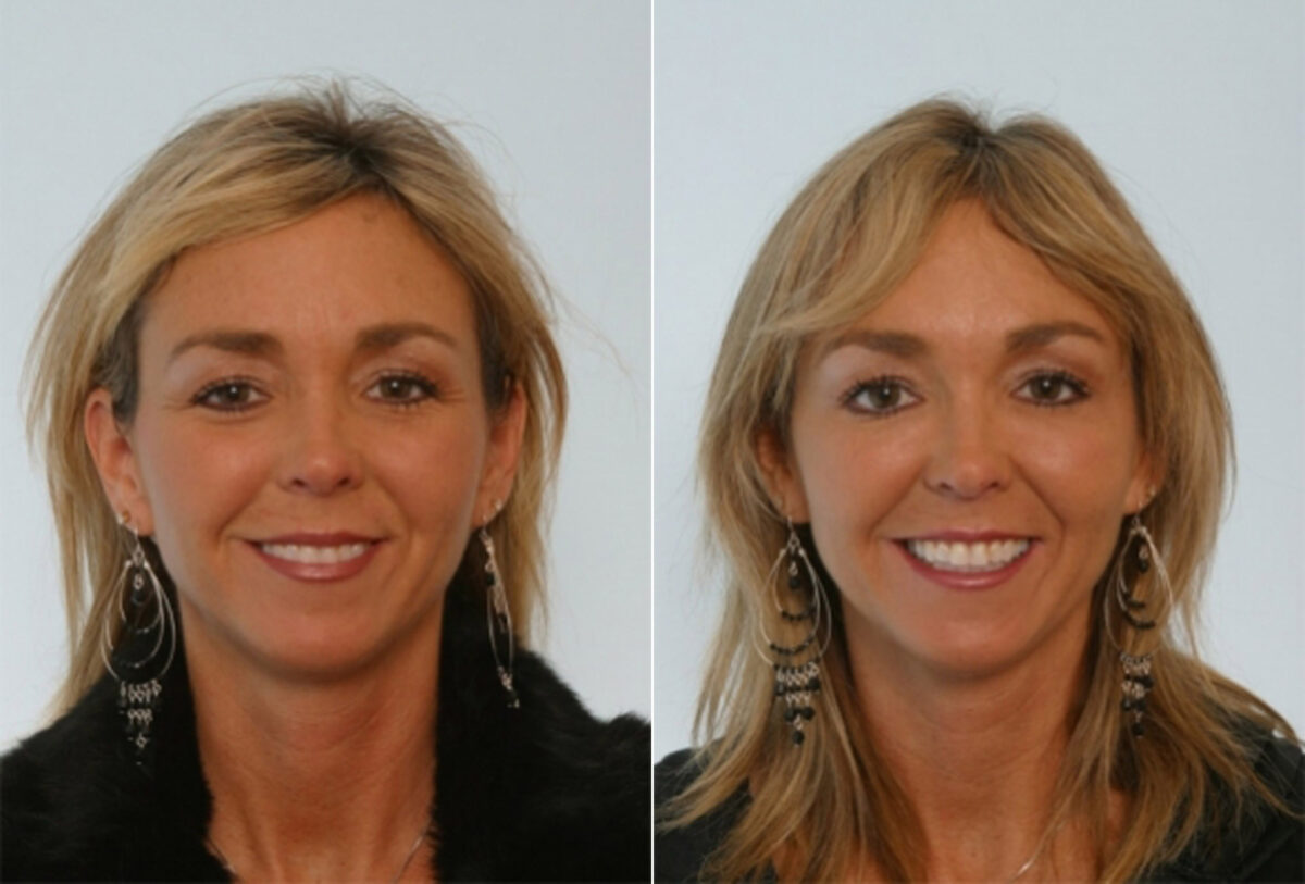Fillers before and after photos in Houston, TX, Patient 28524