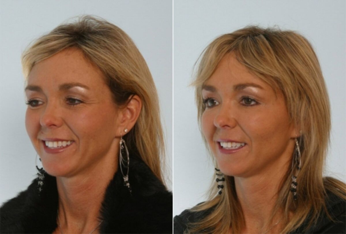 Fillers before and after photos in Houston, TX, Patient 28524
