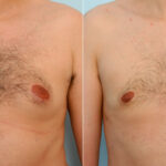 Gynecomastia (Male Breast Reduction) before and after photos in Houston, TX, Patient 28529