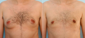 Gynecomastia (Male Breast Reduction) before and after photos in Houston, TX, Patient 28529