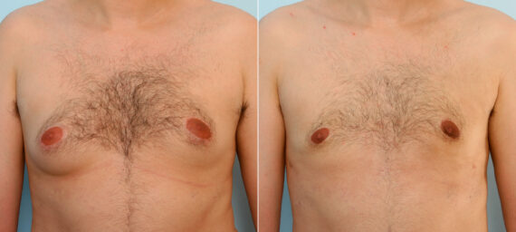 Gynecomastia (Male Breast Reduction) before and after photos in Houston, TX, Patient 28529