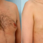 Gynecomastia (Male Breast Reduction) before and after photos in Houston, TX, Patient 28529