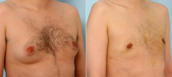 Gynecomastia (Male Breast Reduction) before and after photos in Houston, TX, Patient 28529