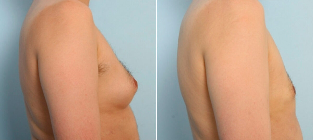 Gynecomastia (Male Breast Reduction) before and after photos in Houston, TX, Patient 28529
