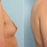 Gynecomastia (Male Breast Reduction) before and after photos in Houston, TX, Patient 28529