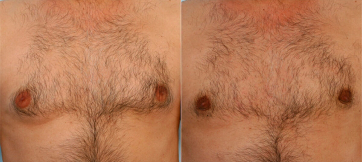 Gynecomastia (Male Breast Reduction) before and after photos in Houston, TX, Patient 28536