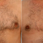 Gynecomastia (Male Breast Reduction) before and after photos in Houston, TX, Patient 28536