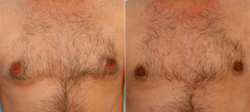 Gynecomastia (Male Breast Reduction) before and after photos in Houston, TX, Patient 28536