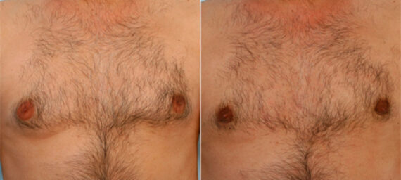 Gynecomastia (Male Breast Reduction) before and after photos in Houston, TX