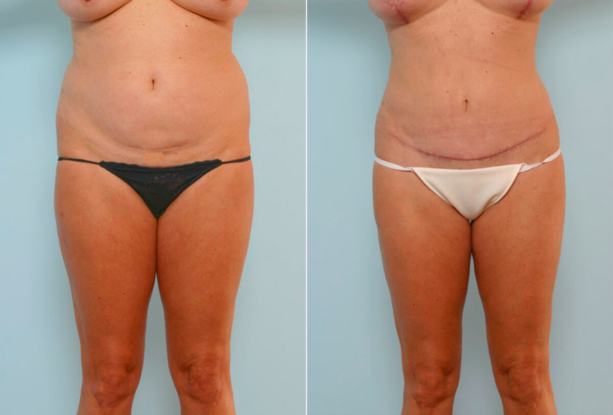 Abdominoplasty before and after photos in Houston, TX, Patient 24633
