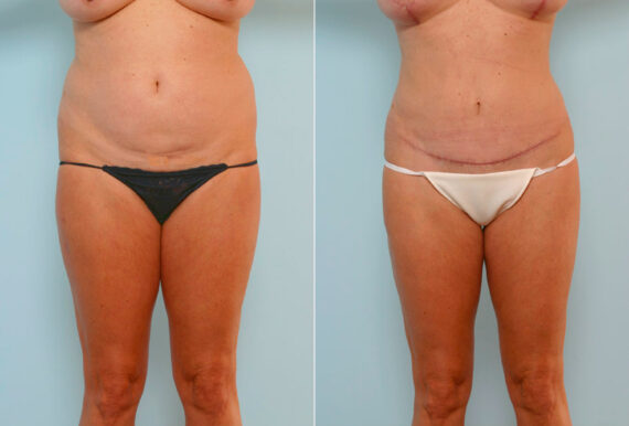 Tummy Tuck/Abdominoplasty before and after photos in Houston, TX, Patient 24633