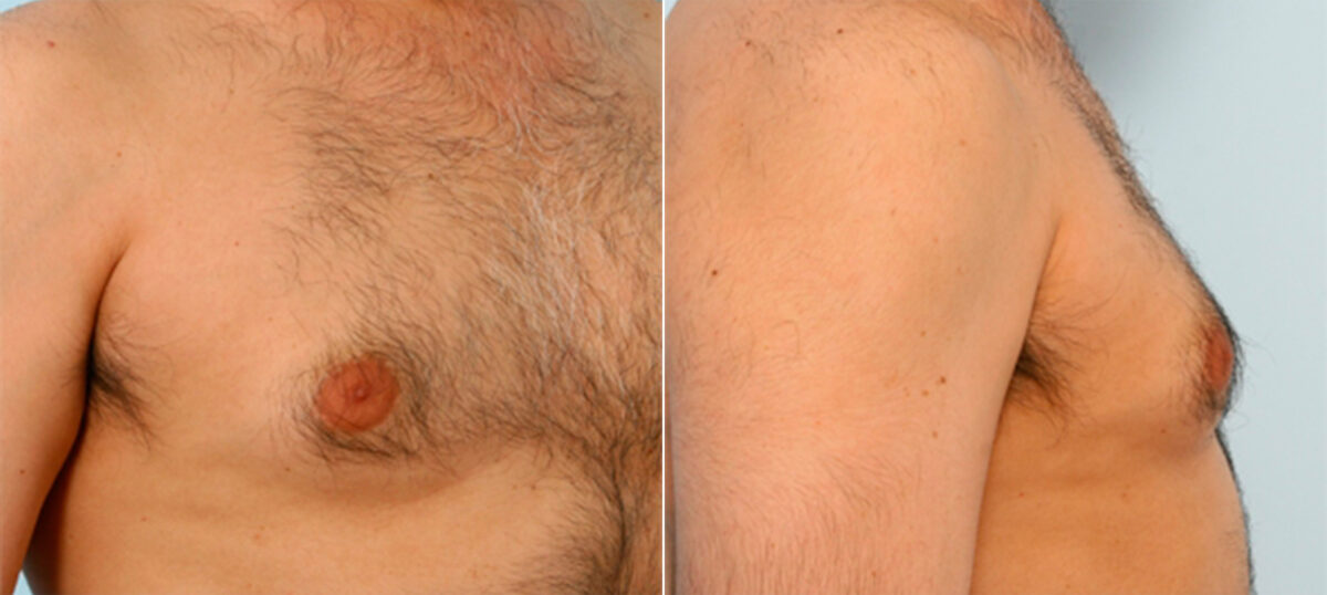 Gynecomastia (Male Breast Reduction) before and after photos in Houston, TX, Patient 28536