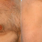 Gynecomastia (Male Breast Reduction) before and after photos in Houston, TX, Patient 28536