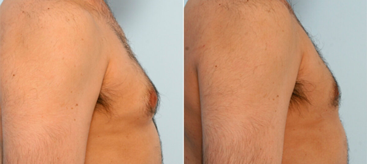 Gynecomastia (Male Breast Reduction) before and after photos in Houston, TX, Patient 28536