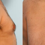 Gynecomastia (Male Breast Reduction) before and after photos in Houston, TX, Patient 28536