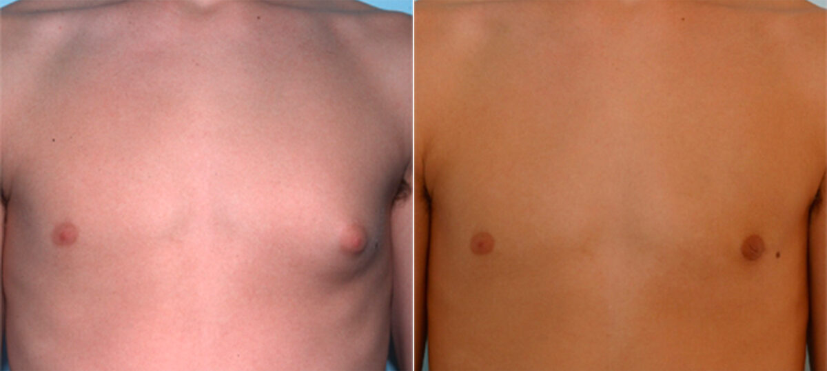 Gynecomastia (Male Breast Reduction) before and after photos in Houston, TX, Patient 28550