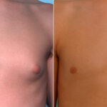 Gynecomastia (Male Breast Reduction) before and after photos in Houston, TX, Patient 28550