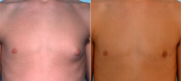 Gynecomastia (Male Breast Reduction) before and after photos in Houston, TX, Patient 28550