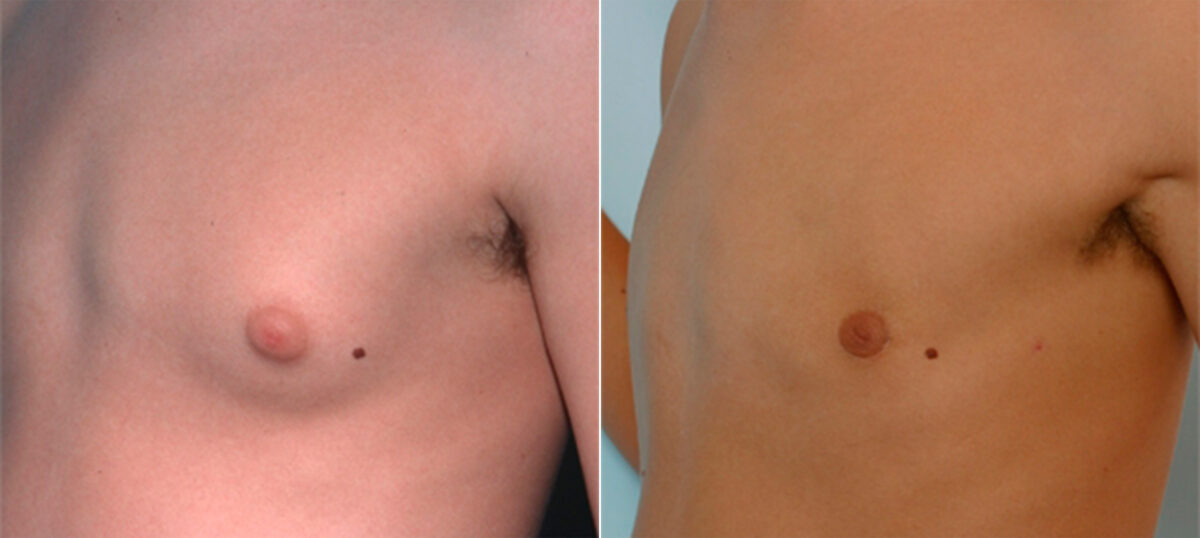 Gynecomastia (Male Breast Reduction) before and after photos in Houston, TX, Patient 28550