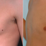 Gynecomastia (Male Breast Reduction) before and after photos in Houston, TX, Patient 28550