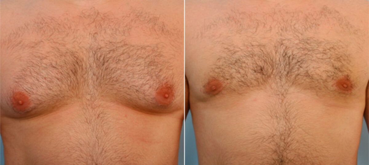 Gynecomastia (Male Breast Reduction) before and after photos in Houston, TX, Patient 28557