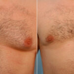 Gynecomastia (Male Breast Reduction) before and after photos in Houston, TX, Patient 28557