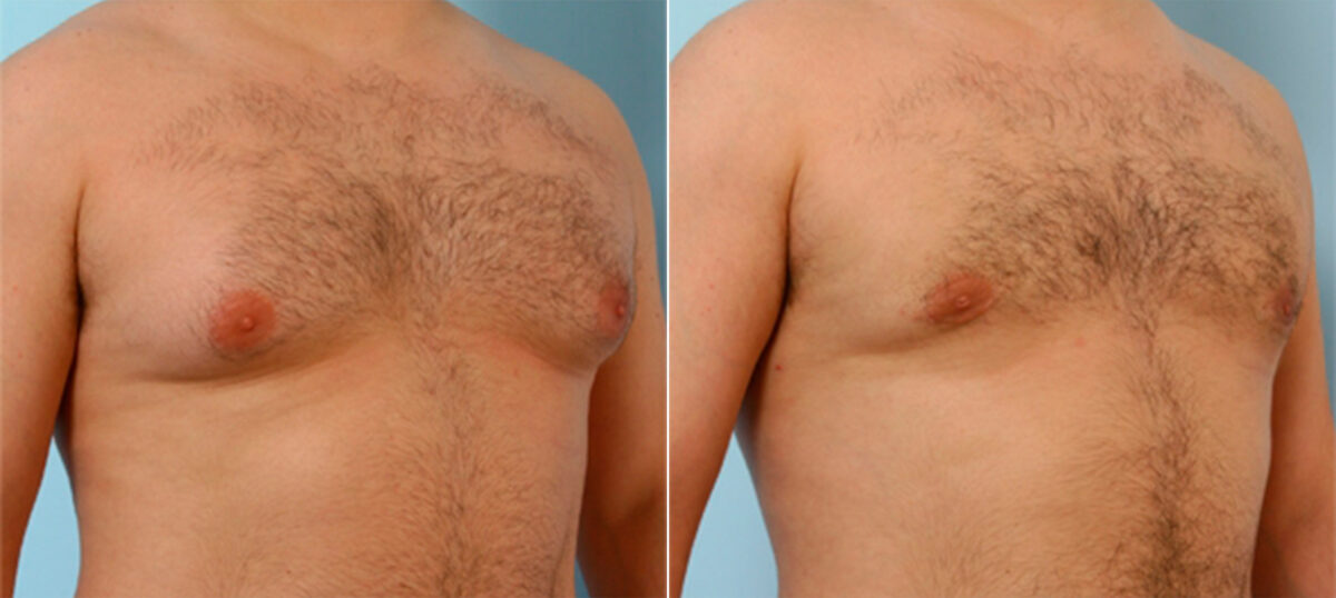 Gynecomastia (Male Breast Reduction) before and after photos in Houston, TX, Patient 28557