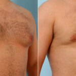 Gynecomastia (Male Breast Reduction) before and after photos in Houston, TX, Patient 28557