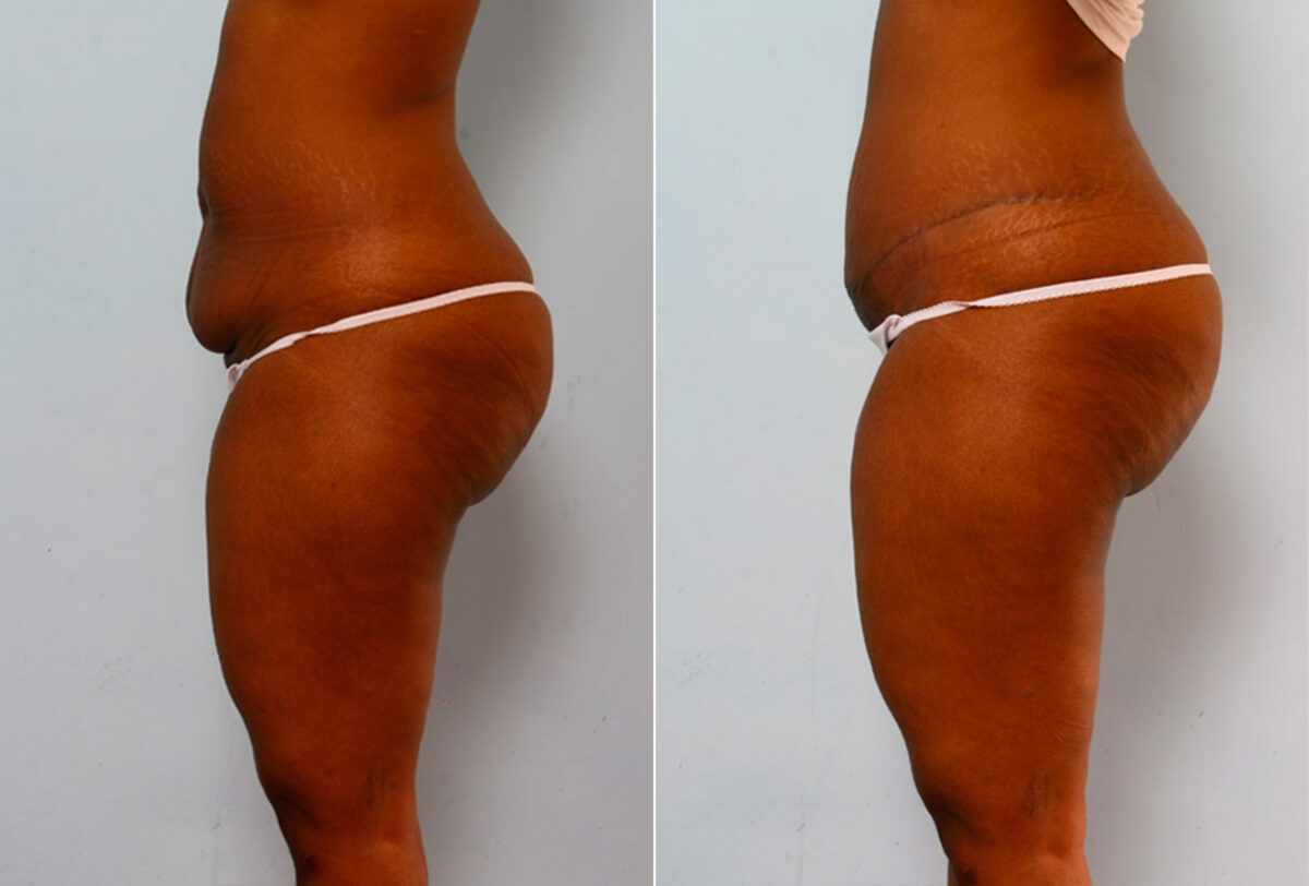 Tummy Tuck/Abdominoplasty before and after photos in Houston, TX, Patient 24232