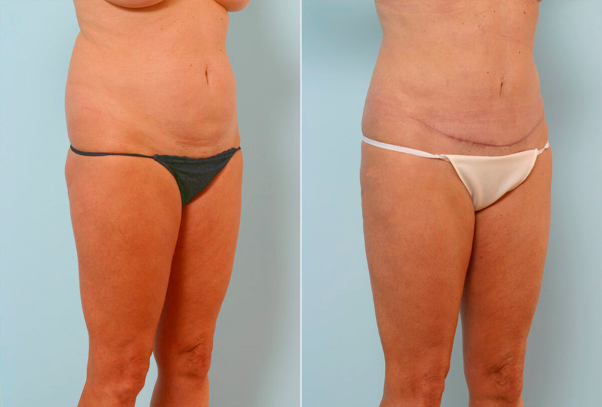 Abdominoplasty before and after photos in Houston, TX, Patient 24633