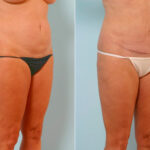 Abdominoplasty before and after photos in Houston, TX, Patient 24633
