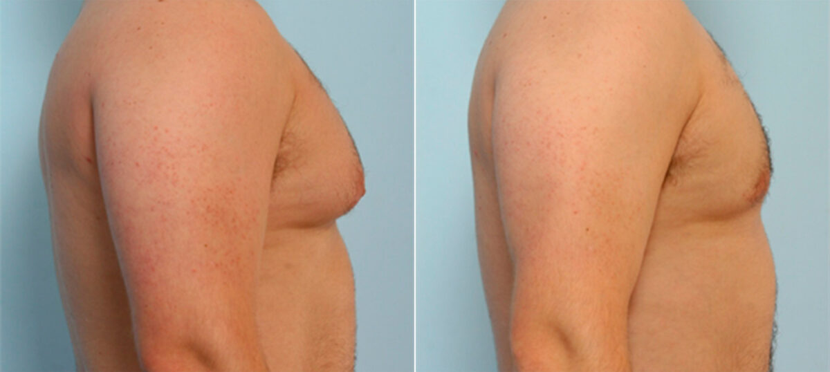 Gynecomastia (Male Breast Reduction) before and after photos in Houston, TX, Patient 28557