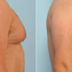 Gynecomastia (Male Breast Reduction) before and after photos in Houston, TX, Patient 28557