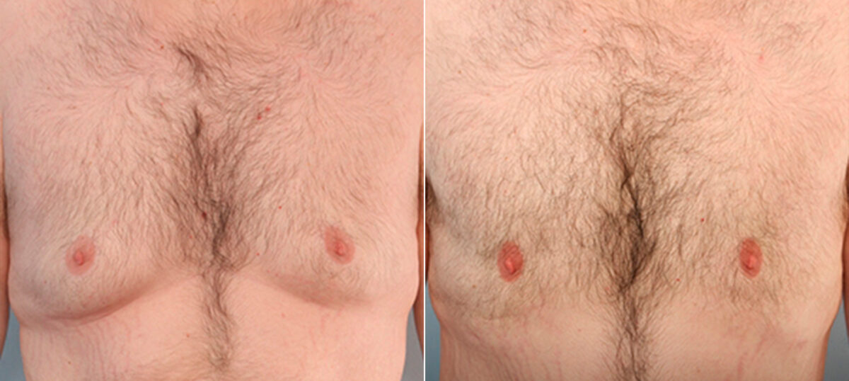 Gynecomastia (Male Breast Reduction) before and after photos in Houston, TX, Patient 28571