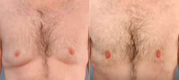Gynecomastia (Male Breast Reduction) before and after photos in Houston, TX, Patient 28571