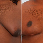 Gynecomastia (Male Breast Reduction) before and after photos in Houston, TX, Patient 28574